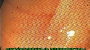 Дивертикулёз  без дивертикулита. Колоноскопия.