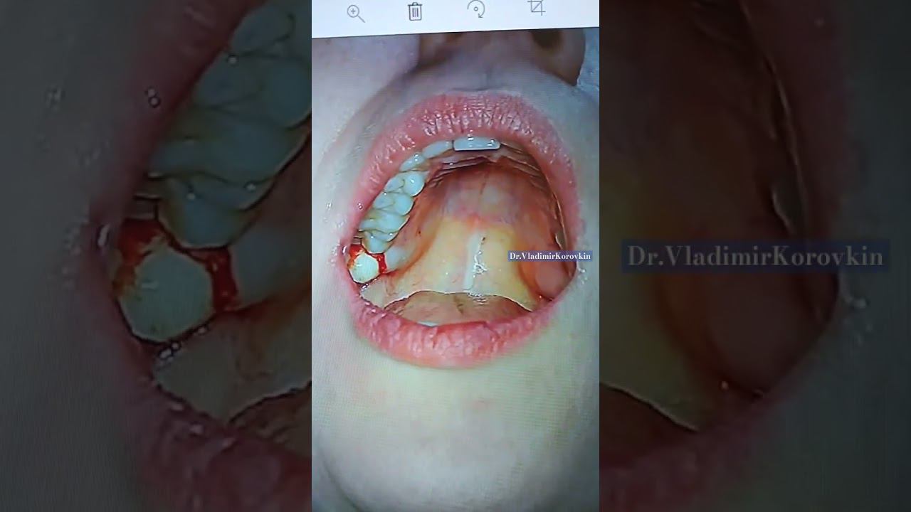 Удаление 18 зуба.#localanesthesia #extractionteeth