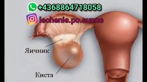 Перевод отзыва лечившейся с диагнозом фолликулярная киста яичника.