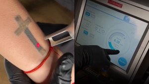 Удаление тату и татуажа пикосекундный лазером PIcoplus