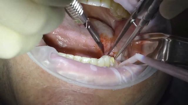 Удаление зуба 37 смотреть онлайн