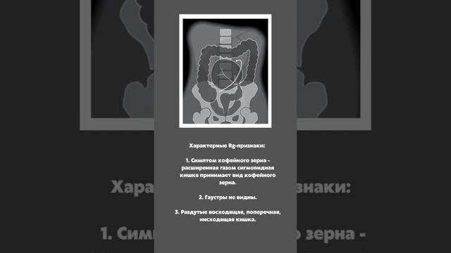 Заворот сигмовидной кишки | Рентген-диагностика | Обязательно знать каждому хирургу