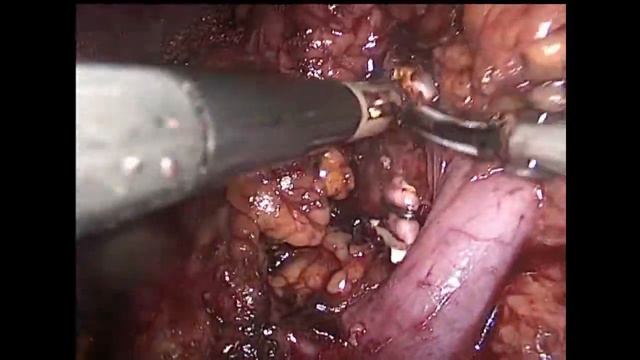 Laparoscopic Left Nephrectomy / Лапароскопическая нефрэктомия слева смотреть онлайн