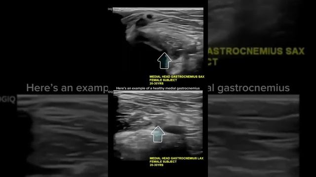 #ultrasound Guided Interventions: Healthy Images (Medial Gastrocnemius)