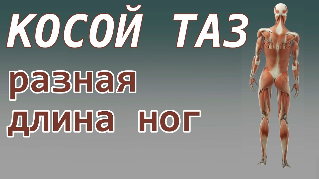 ? Косой таз; разная длина ног (симптомы, причины и лечение)