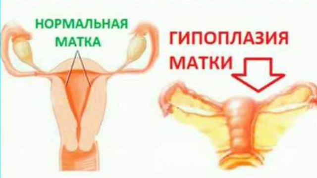 БАЧАДОН КИЧИКЛИГИ БАЧАДОН ГИПОПЛАЗИЯСИ, САБАБЛАРИ, БЕЛГИЛАРИ