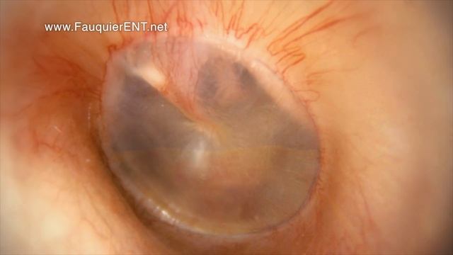 Clogged Ear Due to Ear Infection or Eustachian Tube Dysfunction смотреть онлайн