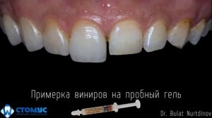 Виниры без обточки зубов