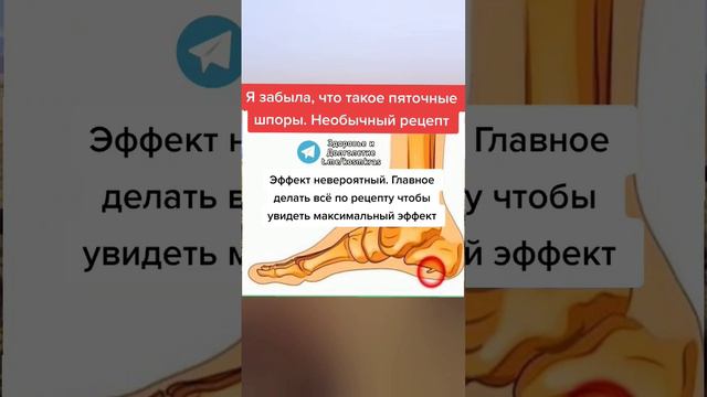 Я забыла что такое пяточные шпоры #полезныесоветы #здоровье #зож #медицина смотреть онлайн