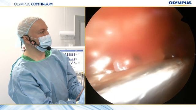 ЭНДОНАЗАЛЬНАЯ ХИРУРГИЯ В ЛЕЧЕНИИ ОПУХОЛЕЙ ПОЛОСТИ НОСА И ПРИДАТОЧНЫХ ПАЗУХ смотреть онлайн