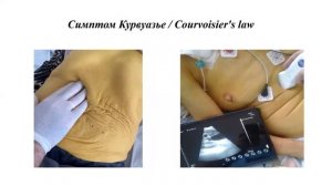 Симптом Курвуазье. Поздний признак опухолевой механической желтухи.