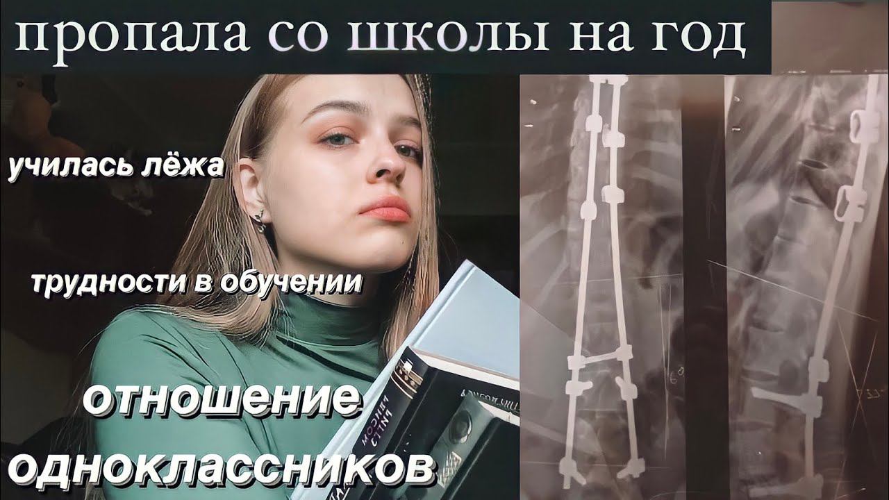 ОГРАНИЧЕНИЯ после операции на СКОЛИОЗ 4 степени / домашнее обучение / как учиться?