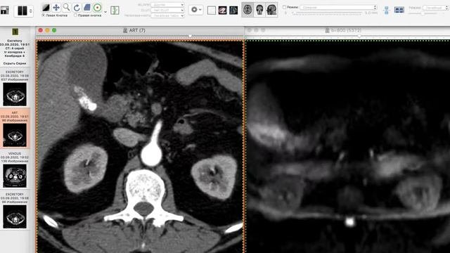 Osirix -Horos - Miele - Fusion КТ и МРТ. Часть 2 - диффузия в изображениях КТ.