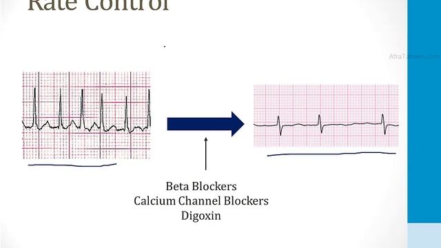 Кардиология USMLE - 4. Аритмии - 3.Мерцательная аритмия и Трепетание предсердий (Boards and Beyond)