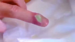 Выдавливание гноя из пальца