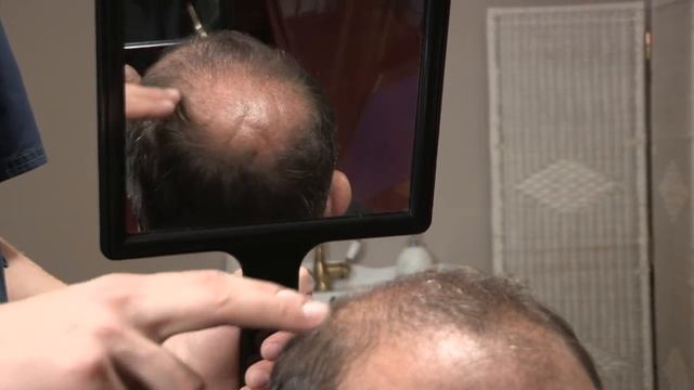 Трихолог после пересадки? Зачем?