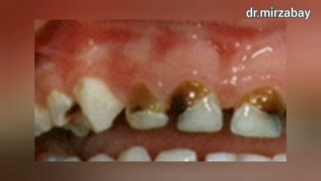 Тіс жегісі тис ауруы тис жегісін емдеу кариести емдеу лечение кариеса тис ауырса уй жагдайында не и