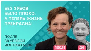 Имплантация зубов эффективнее филлеров! Омоложение после стоматолога
