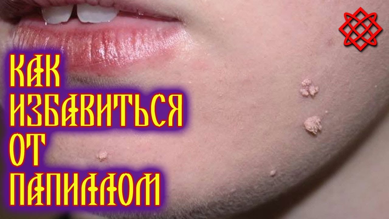 КАК ИЗБАВИТЬСЯ ОТ ПАПИЛЛОМ. Народные Средства для Лечения и Удаления Папиллом.mp4 смотреть онлайн