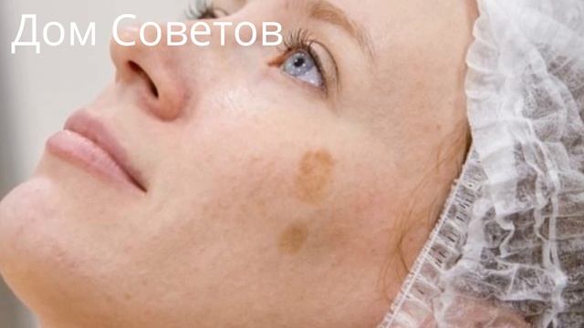 Как быстро избавиться от Пигментных Пятен при помощи Копеечных Средств смотреть онлайн