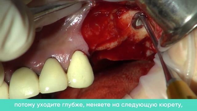 Универсальный набор для синус-лифтинга SAVE Sinus от Dentis. Видеообзор доктора Шумовского Д.Б.