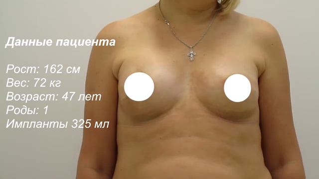 Увеличение груди смотреть онлайн