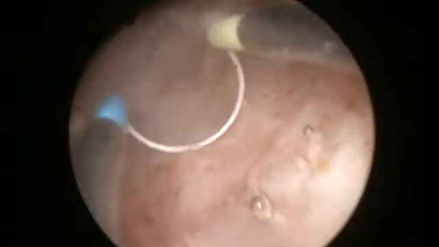 Διουρηθρική προστατεκτομή TURis Δρ. Κυμηνάς Ευάγγελος www.kyminas-urology.gr смотреть онлайн