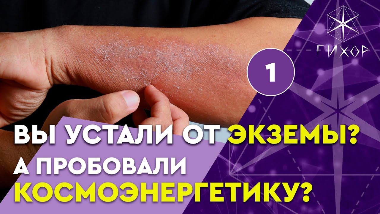 Интервью. Вы устали от экземы? А пробовали космоэнергетику?
