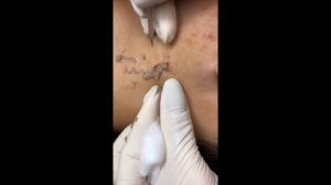 ОГРОМНОЙ ГНОЙНИК У ПАРНЯ НА ЛИЦЕ(18+)