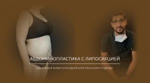 Один месяц после липоабдоминопластики с липосакцией спины и рук