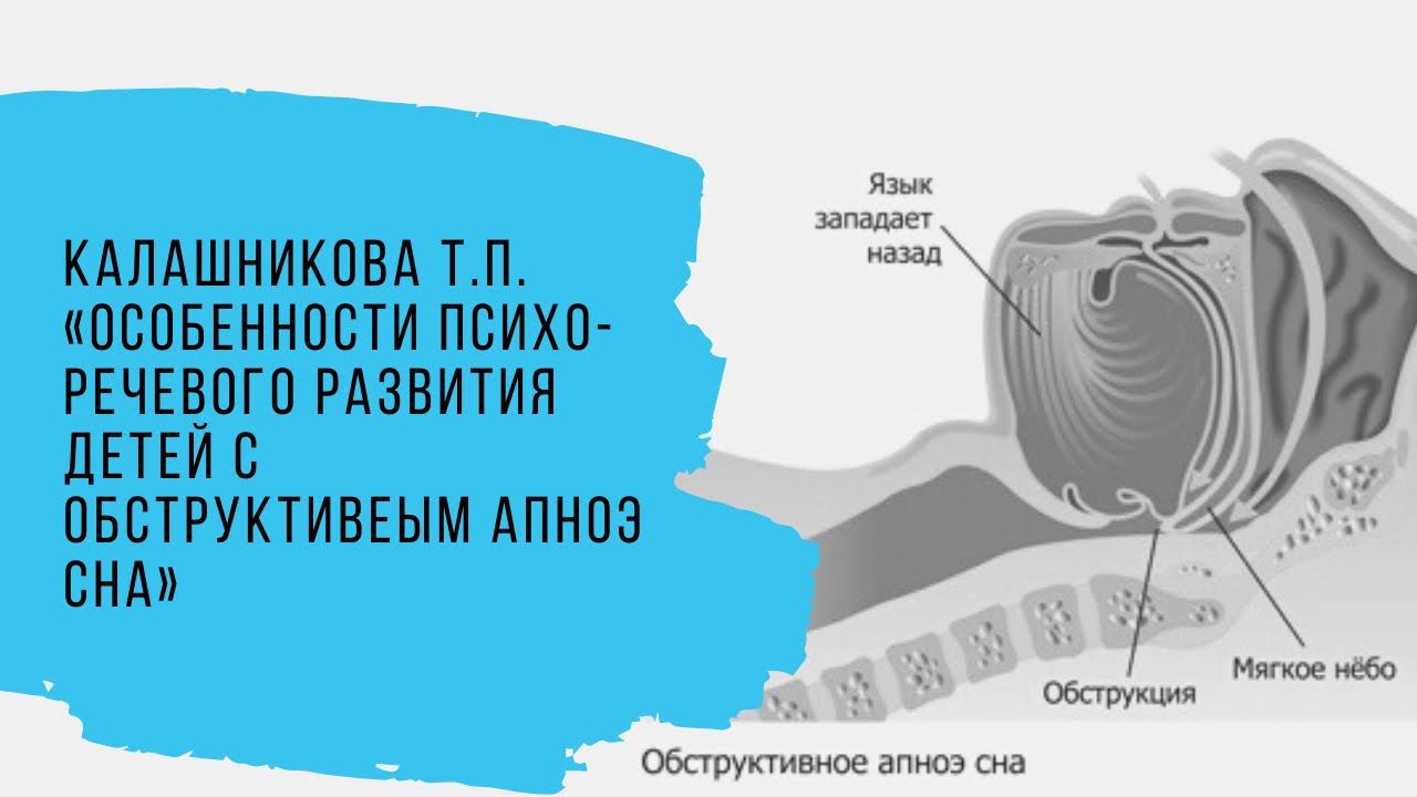 Калашникова ТП «Особенности психо-речевого развития детей с обструктивным апноэ сна"
