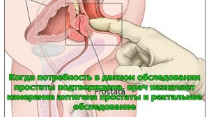 Как проходит обследование простаты?