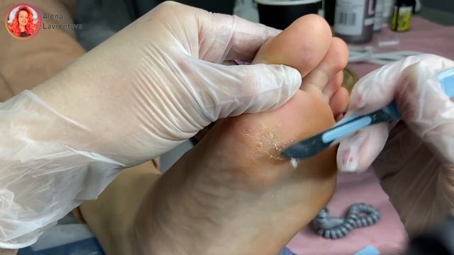 Бородавки на стопе / удаление азотной кислотой / выжигание