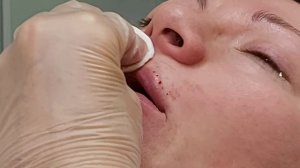 АирисКом студенты учатся: коррекция губ, линейная техника. Филлер princess 0.5 мл.