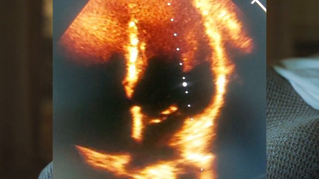 Prolapso valvular mitral.