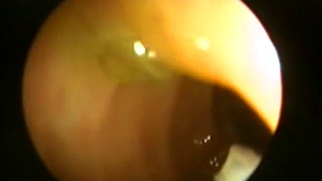 Иссечение полипа  Колоноскопия смотреть онлайн