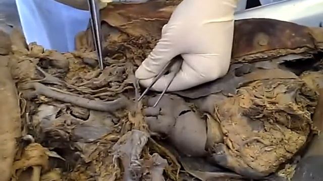 Топографическая анатомия шеи. Часть 2 смотреть онлайн