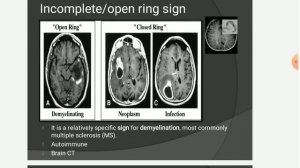 |CT Radiological signs| Brain,kidneys,lungs,liver,GIT|