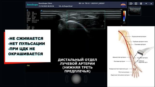 Тромбоз лучевой артерии