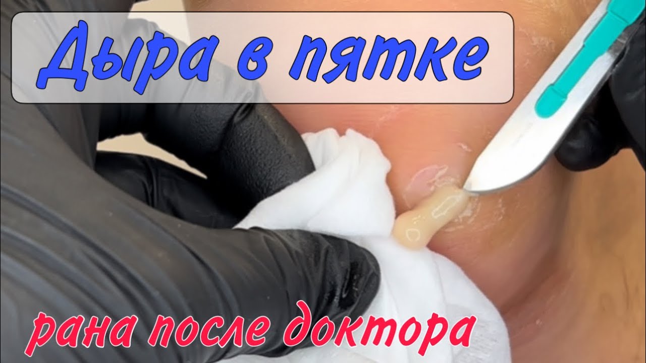 😱ГНОЙ в пятке _ работа СКАЛЬПЕЛЕМ🗡️ _ боль в пятке смотреть онлайн