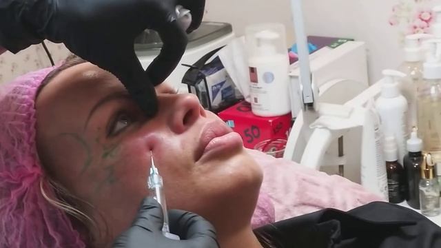 ПЕРИОРБИТАЛЬНАЯ область. КАНЮЛЯ(фрагмент) смотреть онлайн