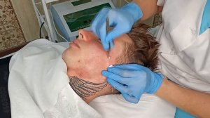 Механическая чистка лица