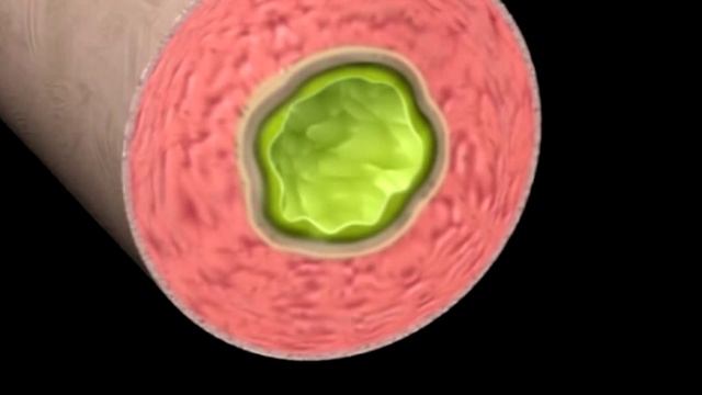 Бронхиальная астма смотреть онлайн