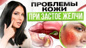 10 признаков застоя желчи на коже. Что кожа расскажет о твоем желчном?