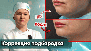 Коррекция подбородка