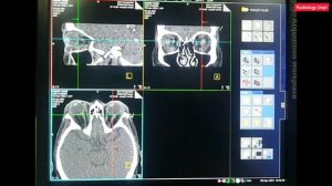 CT ORBIT Scan Easy Filming  Technique |#Hindi #Seimens CT Orbit Scan | #Ct #OrbitFilming Eyesfilmin