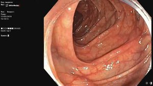 Дивертикулёз