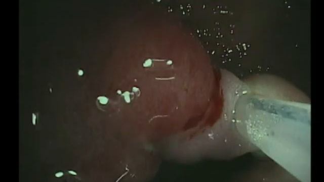 Полипэктомия (polypectomy)