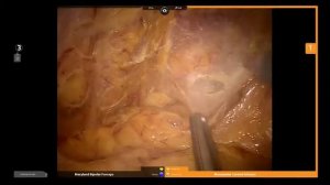 Robotic low anterior resection (Робот-ассистированная резекция прямой кишки)