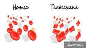 Талассемия. Как лечить талассемию.